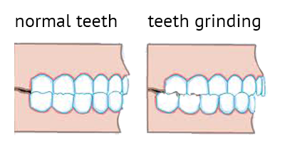grinding teeth symptoms